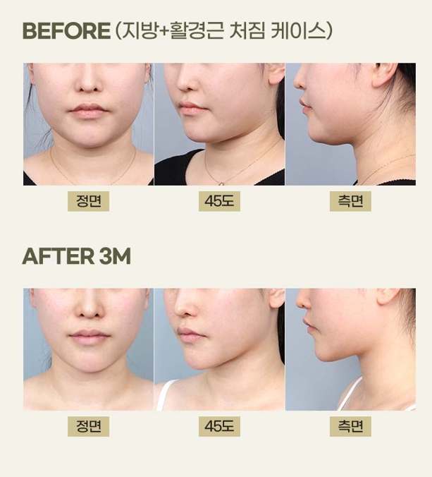What Is Double-Chin Muscle Tightening? An Introduction to Improvement Methods by Cause image 11
