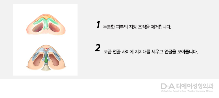 유형별 코성형의 특징과 방법 관련 이미지 6
