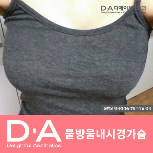 디에이성형외과의 자연스럽고 예쁜 물방울가슴성형 관련 이미지 1