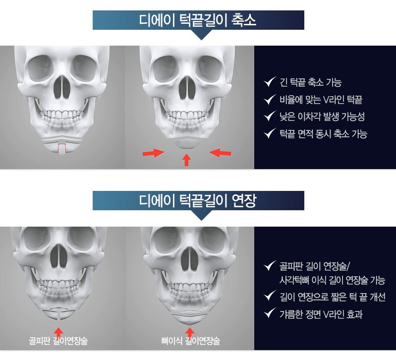 [디에이성형외과] 턱끝성형술 논문 발표 관련 이미지 5