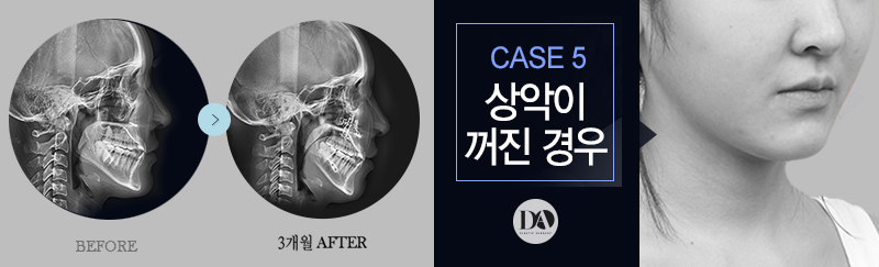 양악수술, 유형별 솔루션 바로 알기 관련 이미지 11