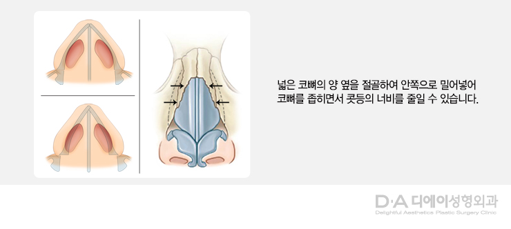 유형별 코성형의 특징과 방법 관련 이미지 14