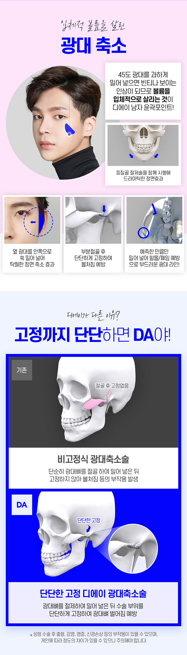 남자 윤곽 수술 알아볼 때 주의사항 관련 이미지 3