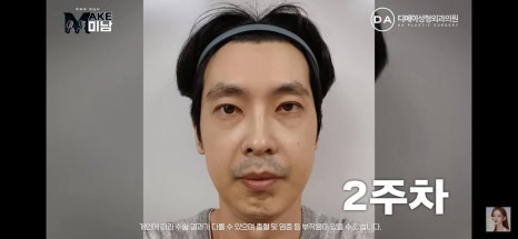 디에이성형외과 | 맥미남 시한폭탄내남자 개인인터뷰 근황 느낀점 관련 이미지 23