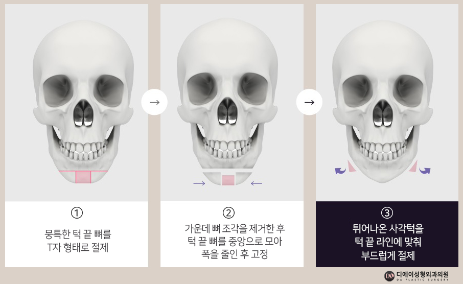 자연스러운 남자성형을 원한다면 관련 이미지 14