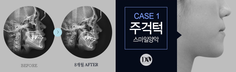 양악수술, 유형별 솔루션 바로 알기 관련 이미지 7