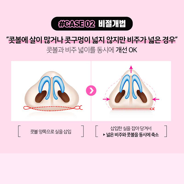 What Matters More Than a Nasal Ala Reduction Review image 6