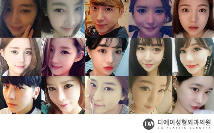 성공적인 눈성형, 관건은 눈형태에 따른 수술법 선택 관련 이미지 20