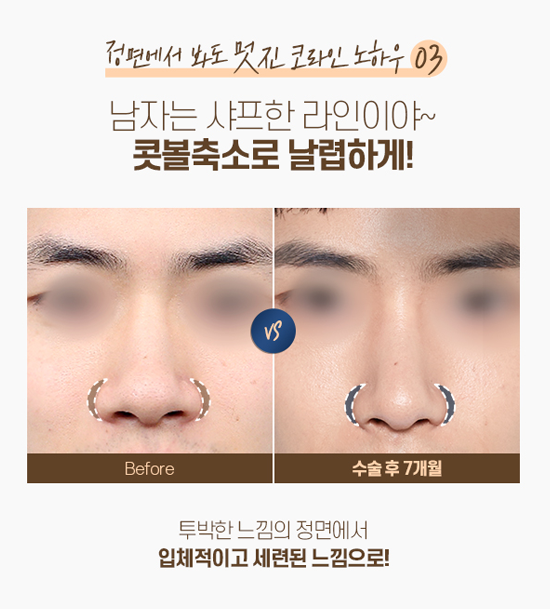 DA FOR MAN, 디에이성형외과 남자 코성형 관련 이미지 6