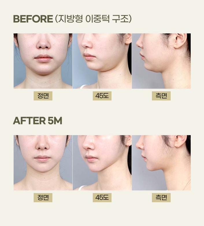 What Is Double-Chin Muscle Tightening? An Introduction to Improvement Methods by Cause image 7