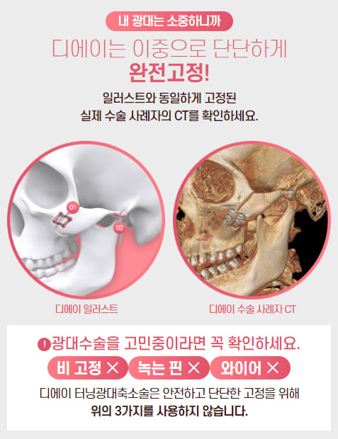 안전하지만 효과적으로, 광대축소술 관련 이미지 6