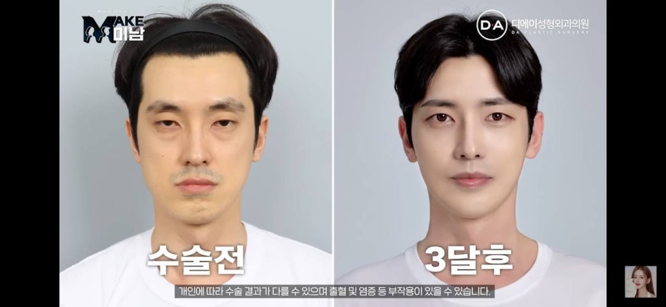 디에이성형외과 | 맥미남 시한폭탄내남자 개인인터뷰 근황 느낀점 관련 이미지 104