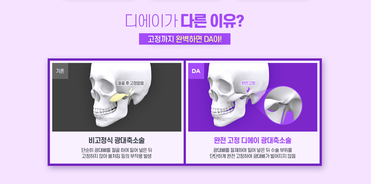 디에이성형외과, 윤곽3종으로 예쁨 UP 관련 이미지 8