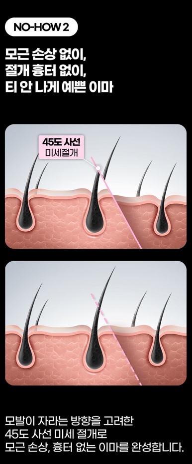 이마축소 수술, 헤어라인만으로 달라지는 얼굴 비율 관련 이미지 7