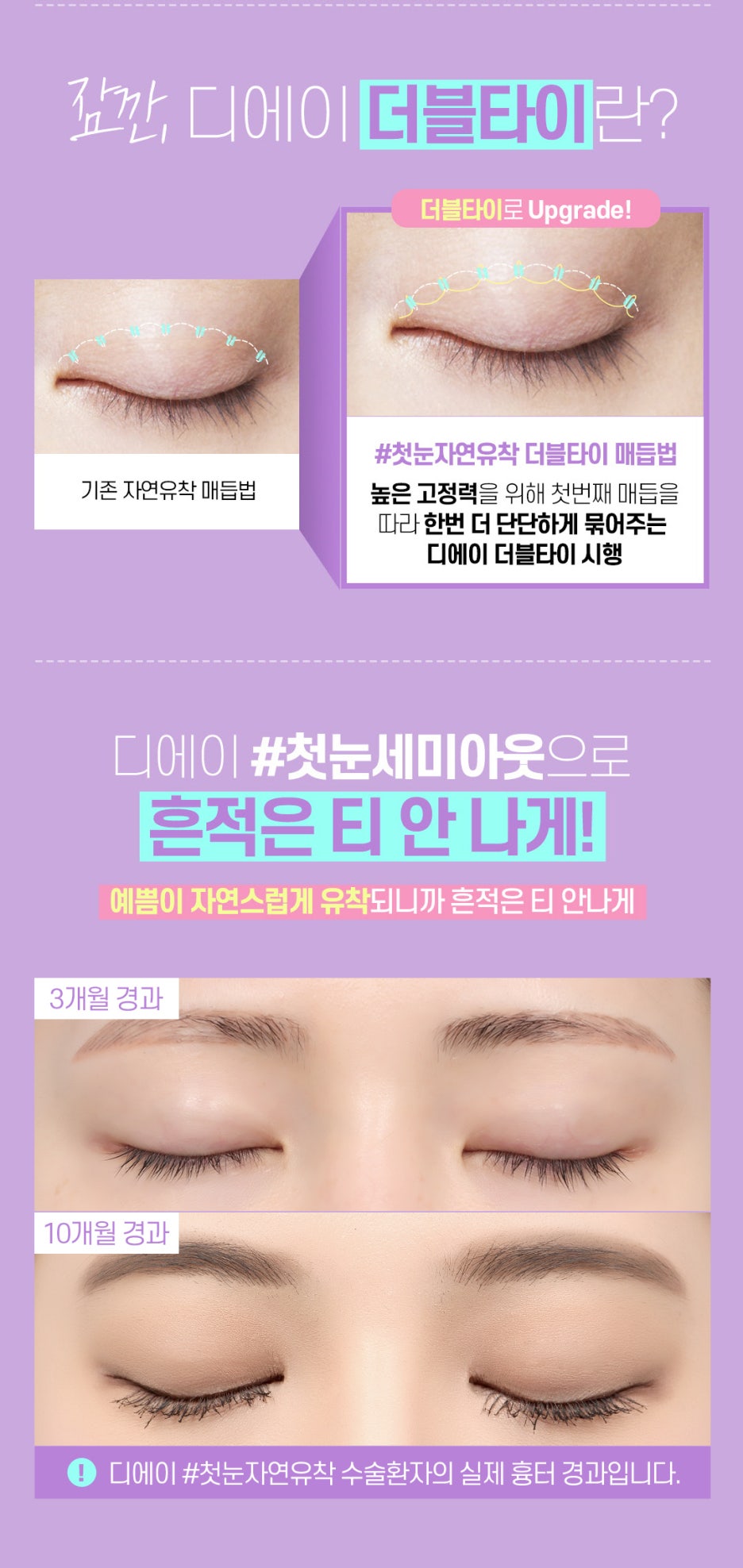 강남 세미아웃 쌍커풀수술 잘 하는 곳 관련 이미지 6