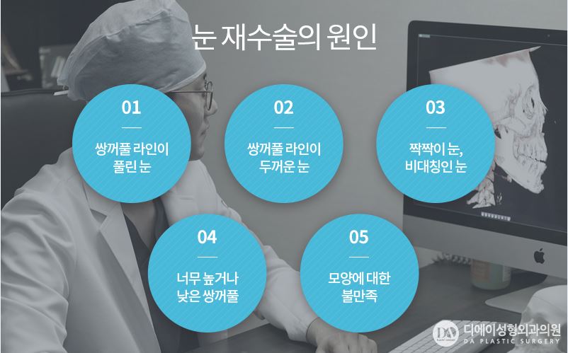 눈재수술 더이상의 실패는 NO! 관련 이미지 3