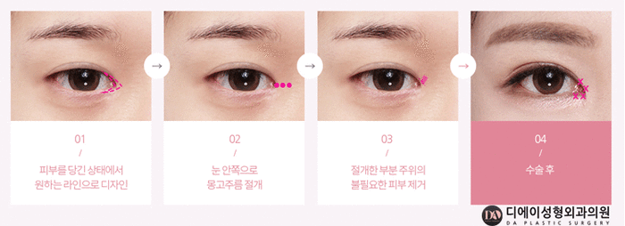 성공적인 눈성형, 관건은 눈형태에 따른 수술법 선택 관련 이미지 5