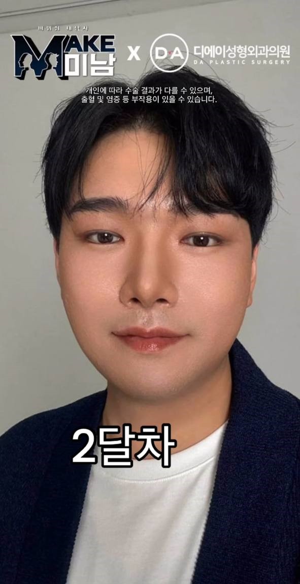 맥미남(MAKE미남) 디에이성형외과 의벤져스 출연 관련 이미지 5