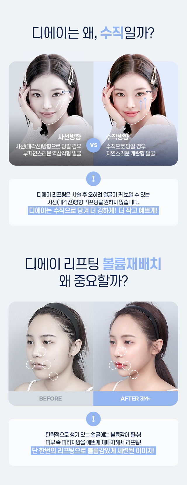 미니리프팅 후기 가격 통증 관련 이미지 5