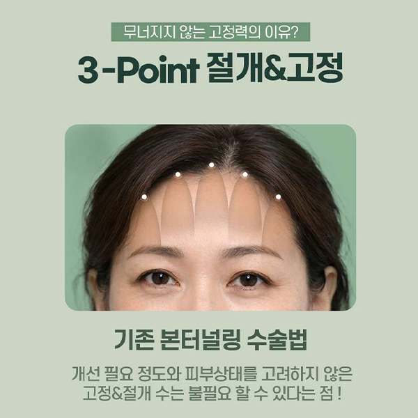 이마주름과 눈처짐을 동시에 개선, 수직 이마거상 관련 이미지 8