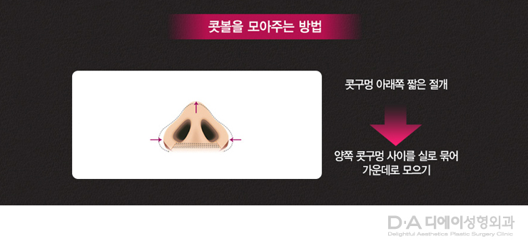 유형별 코성형의 특징과 방법 관련 이미지 21