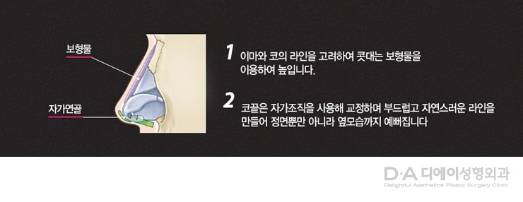유형별 코성형의 특징과 방법 관련 이미지 6