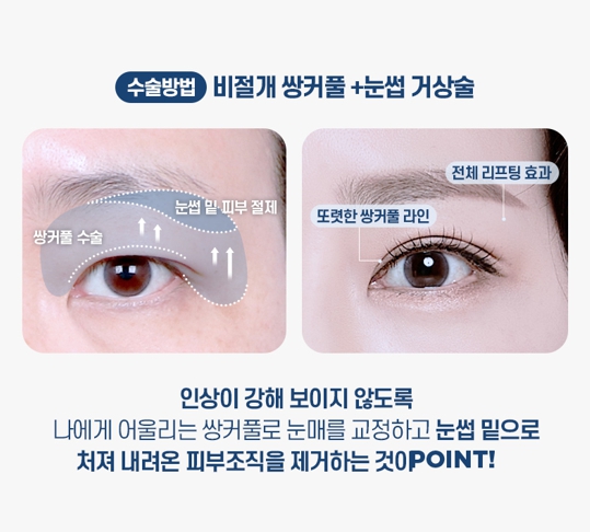중년 눈성형, 처진 눈꺼풀의 원인에 따라 수술법이 달라집니다 관련 이미지 8