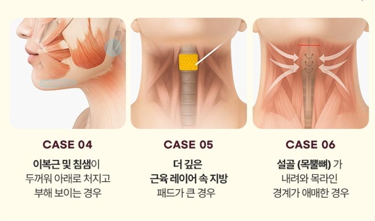 Double Chin Removal Surgery: Essential Information from Effects to Recovery Time image 5