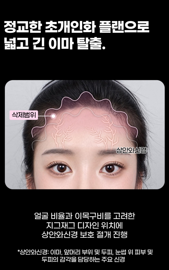 이마축소 수술, 헤어라인만으로 달라지는 얼굴 비율 관련 이미지 3