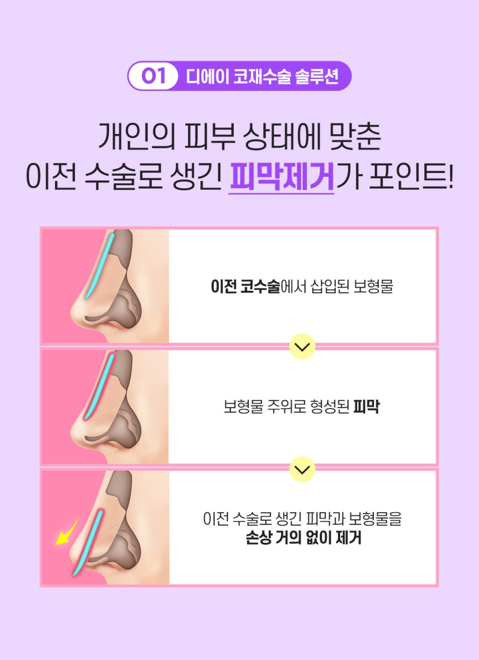 코재수술 후기 비용 신중하게 따져봐야 관련 이미지 4
