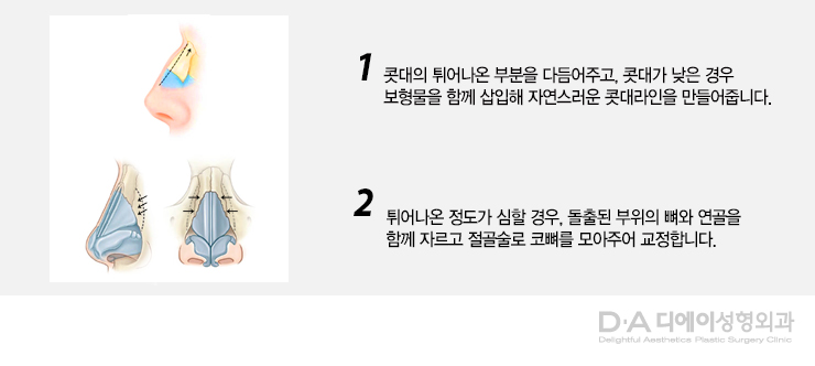 유형별 코성형의 특징과 방법 관련 이미지 11