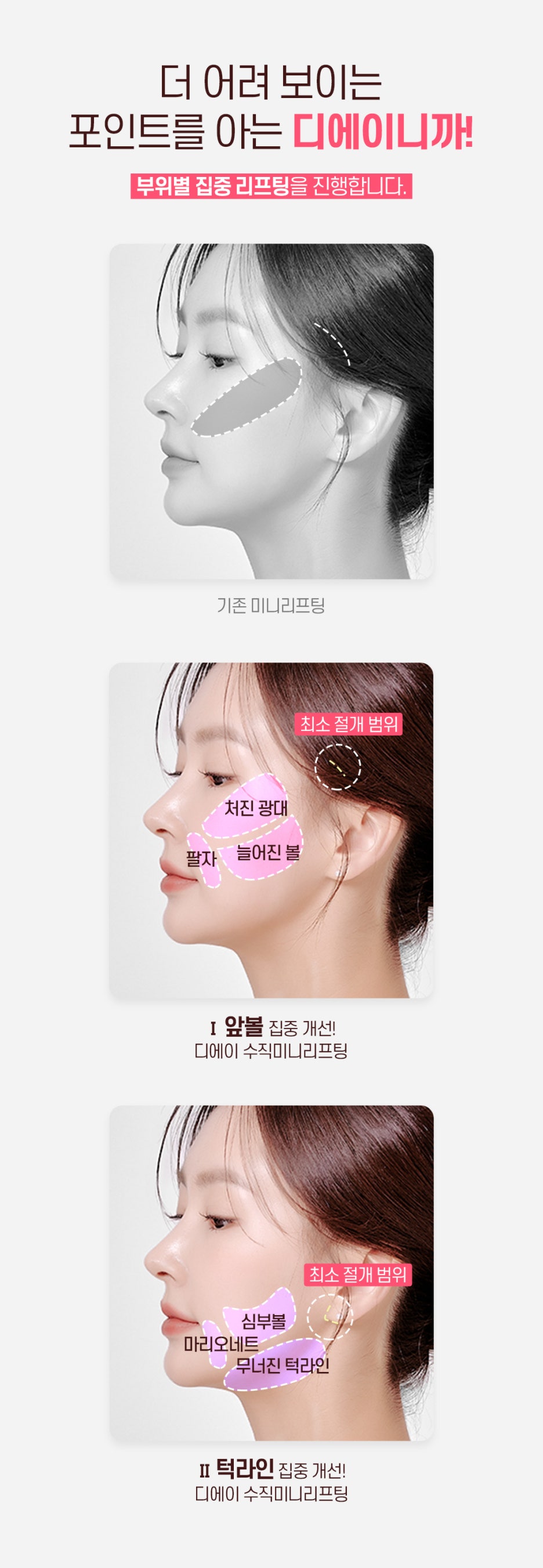 수직미니리프팅 수술법 가격 효과 알아보자면 관련 이미지 5