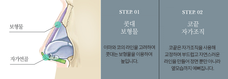 이상적인 코성형, 그 방법은? 관련 이미지 7