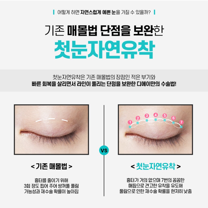 이미지에 맞게 라인 조절이 가능한 눈성형은? 관련 이미지 4