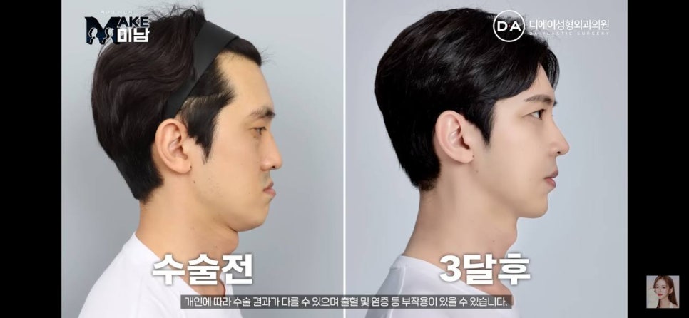 디에이성형외과 | 맥미남 시한폭탄내남자 개인인터뷰 근황 느낀점 관련 이미지 106