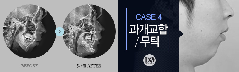 양악수술, 유형별 솔루션 바로 알기 관련 이미지 10