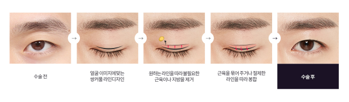 디에이성형외과 맞춤 남자눈성형 솔루션 관련 이미지 7