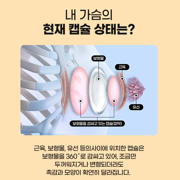 What Is the Best Plan for Breast Revision Surgery to Achieve the Highest Satisfaction? image 4