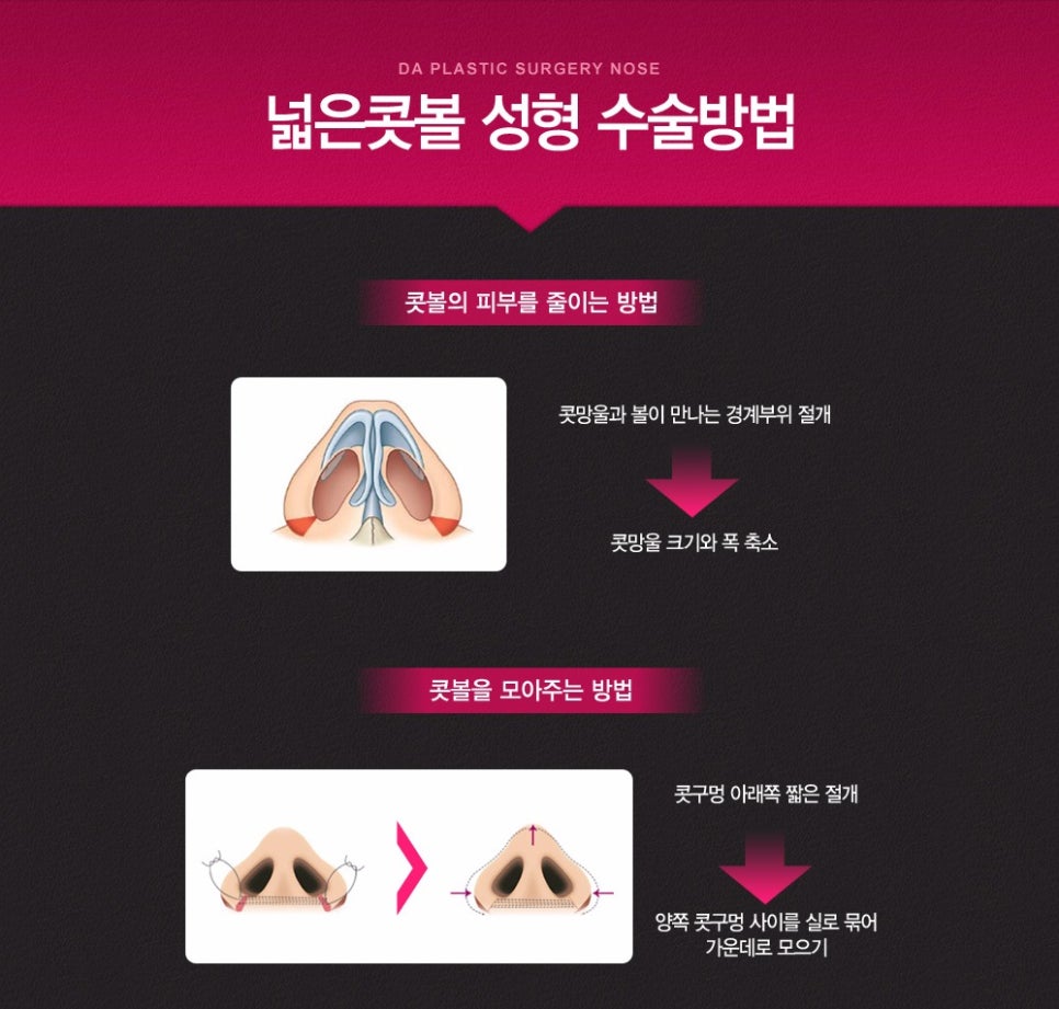 디에이성형외과 콧볼축소수술 관련 이미지 3