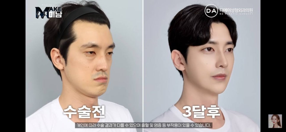 디에이성형외과 | 맥미남 시한폭탄내남자 개인인터뷰 근황 느낀점 관련 이미지 105