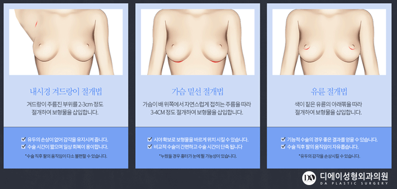 가슴성형 보형물 선택 방법 관련 이미지 6