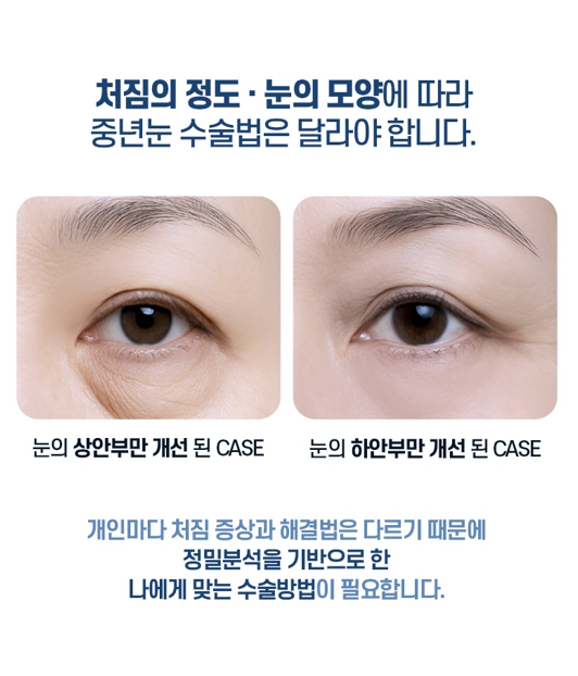 중년 눈성형, 처진 눈꺼풀의 원인에 따라 수술법이 달라집니다 관련 이미지 3