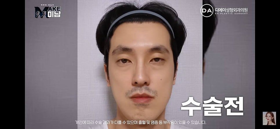 디에이성형외과 | 맥미남 시한폭탄내남자 개인인터뷰 근황 느낀점 관련 이미지 20