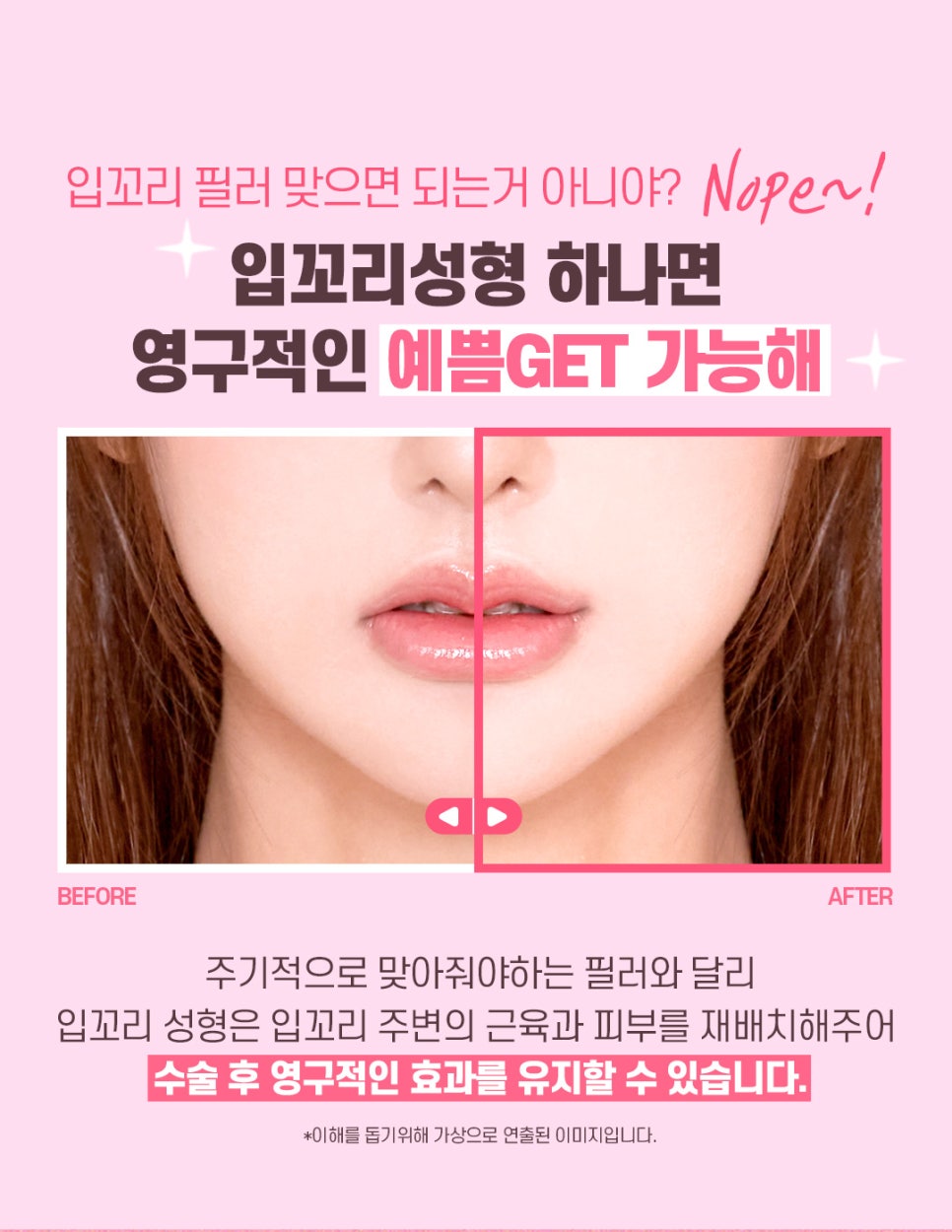 입꼬리성형으로 남심저격 인상되기 관련 이미지 3