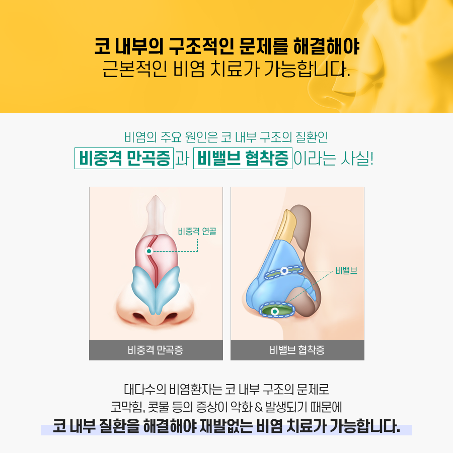 비염수술 코 내부의 구조적 문제를 해결해야 관련 이미지 5