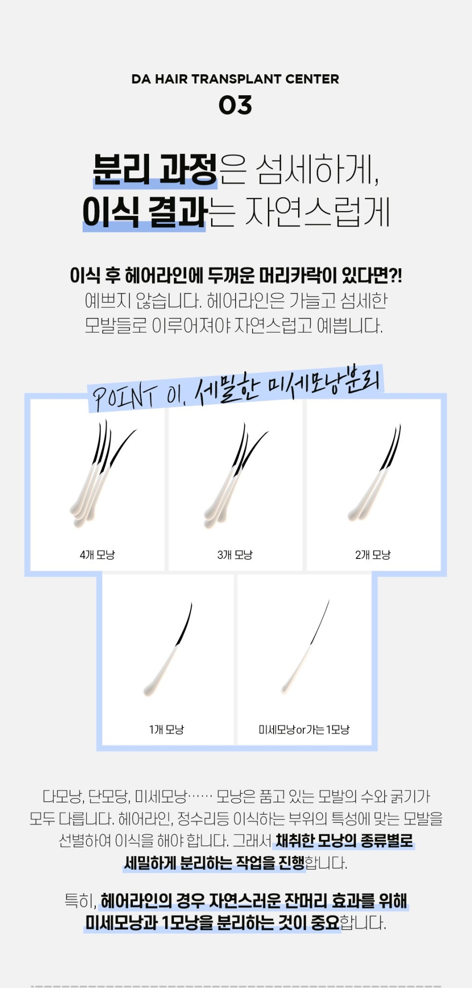 헤어라인 모발이식으로 인형외모갖기 관련 이미지 5