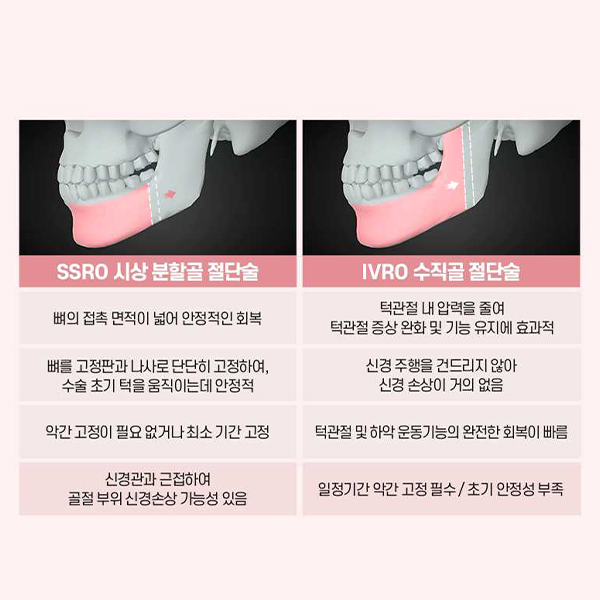 The End of Concerns About a Protruding Mouth &middot; Underbite? Key Information to Know Before Orthognathic Surgery image 9