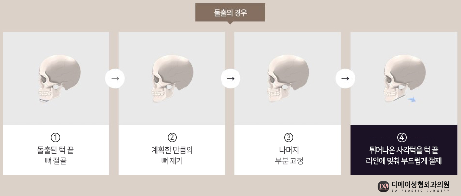 자연스러운 남자성형을 원한다면 관련 이미지 18