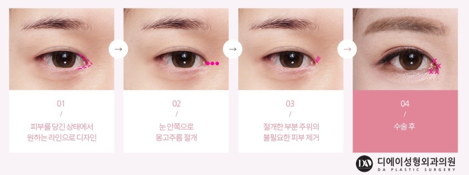 내 눈에 꼭 맞는 수술법은 무엇? 관련 이미지 13