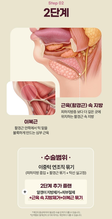Double Chin Removal Surgery: Essential Information from Effects to Recovery Time image 8